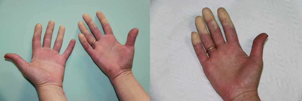 пальцы рук при болезни Рейно